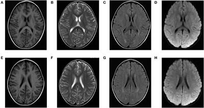 Analysis of the genotype–phenotype correlation in isovaleric acidaemia: A case report of long-term follow-up of a chinese patient and literature review